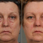 Laser Treatments Before and After Photos in Montvale, NJ, Patient 12850