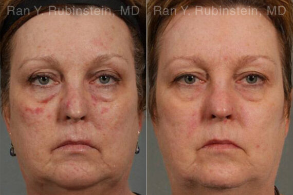 Laser Treatments Before and After Photos in Montvale, NJ, Patient 12850