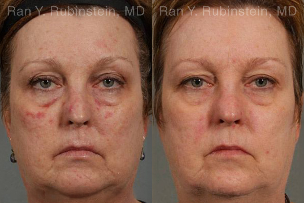 Laser Treatments Before and After Photos in Montvale, NJ, Patient 12850