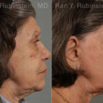 Laser Treatments Before and After Photos in Montvale, NJ, Patient 12855