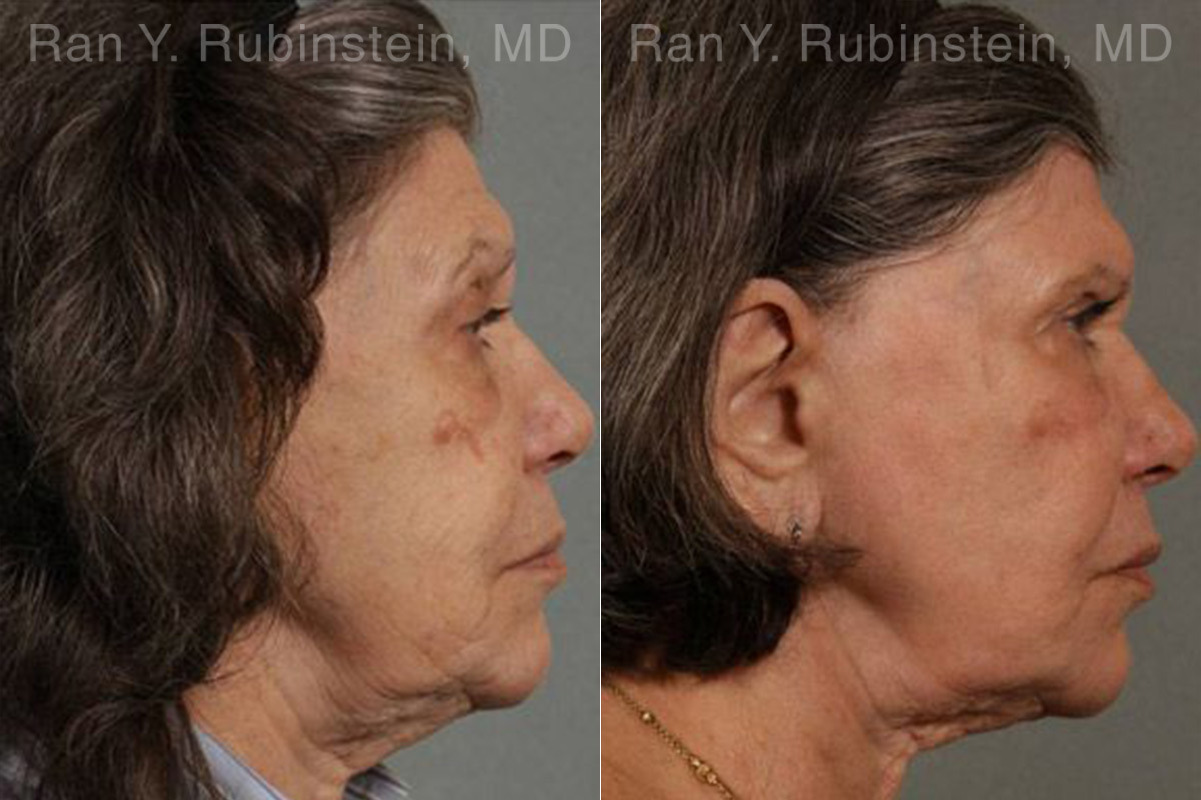 Laser Treatments Before and After Photos in Montvale, NJ, Patient 12855
