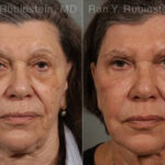 Laser Treatments Before and After Photos in Montvale, NJ, Patient 12855
