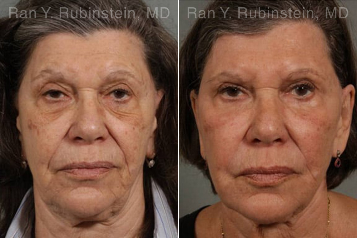 Laser Treatments Before and After Photos in Montvale, NJ, Patient 12855