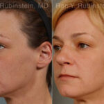 Laser Treatments Before and After Photos in Montvale, NJ, Patient 12860