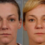 Laser Treatments Before and After Photos in Montvale, NJ, Patient 12860