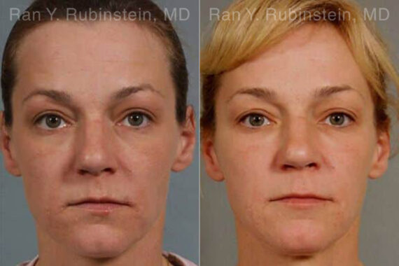 Laser Treatments Before and After Photos in Montvale, NJ, Patient 12860