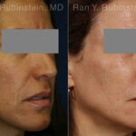 Laser Treatments Before and After Photos in Montvale, NJ, Patient 12865