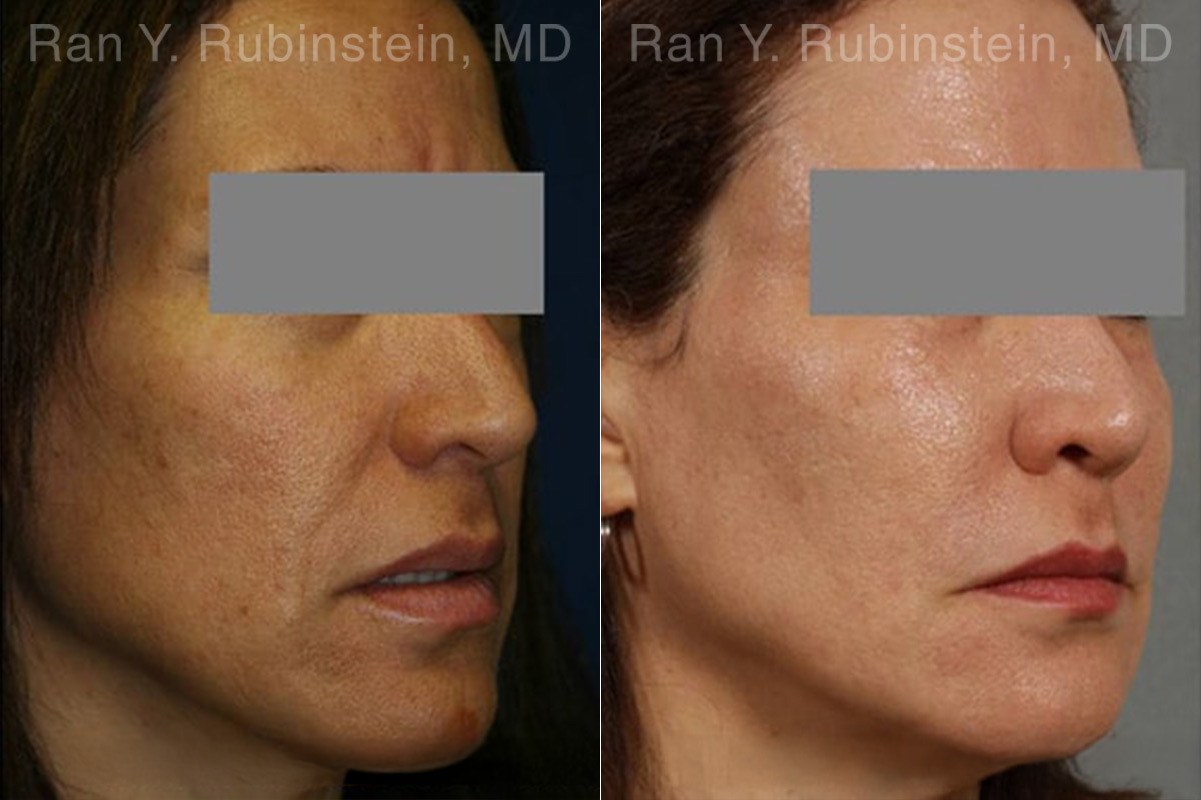 Laser Treatments Before and After Photos in Montvale, NJ, Patient 12865