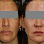 Laser Treatments Before and After Photos in Montvale, NJ, Patient 12865