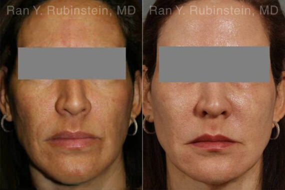 Laser Treatments Before and After Photos in Montvale, NJ, Patient 12865