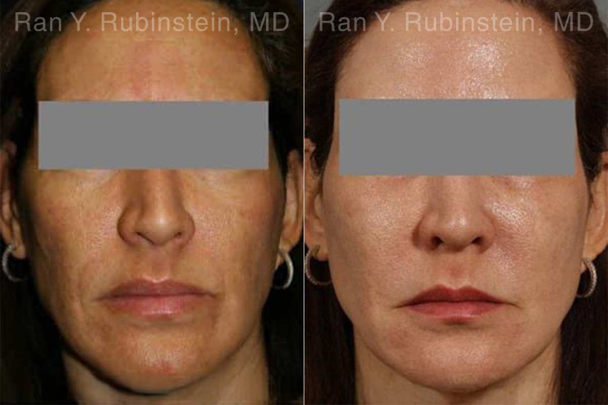 Laser Treatments Before and After Photos in Montvale, NJ, Patient 12865