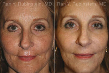 Peels & Microdermabrasion Before and After Photos in Montvale, NJ, Patient 12969