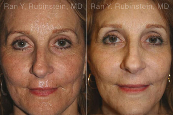Peels & Microdermabrasion Before and After Photos in Montvale, NJ, Patient 12969