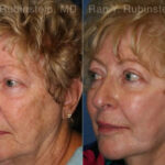 Peels & Microdermabrasion Before and After Photos in Montvale, NJ, Patient 12972