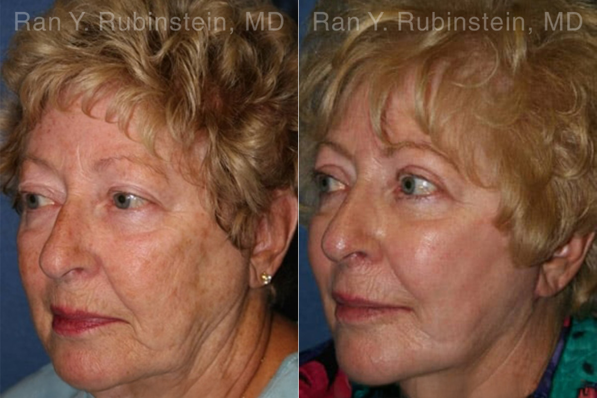 Peels & Microdermabrasion Before and After Photos in Montvale, NJ, Patient 12972