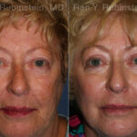 Peels & Microdermabrasion Before and After Photos in Montvale, NJ, Patient 12972