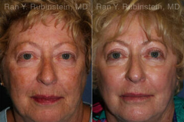Peels & Microdermabrasion Before and After Photos in Montvale, NJ, Patient 12972