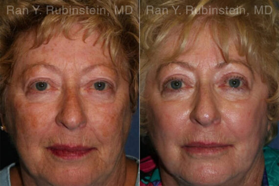 Peels & Microdermabrasion Before and After Photos in Montvale, NJ, Patient 12972