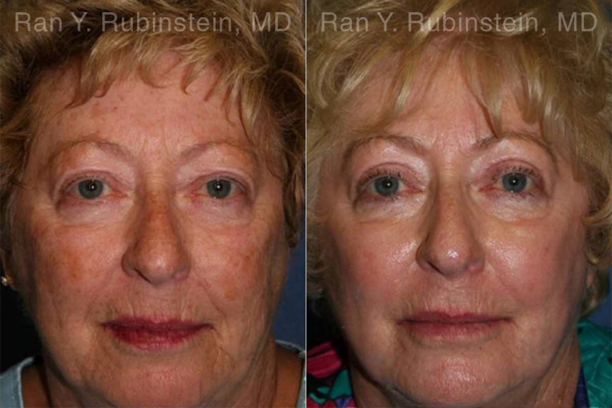 Peels & Microdermabrasion Before and After Photos in Montvale, NJ, Patient 12972