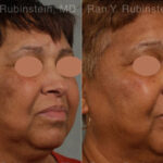 Peels & Microdermabrasion Before and After Photos in Montvale, NJ, Patient 12977