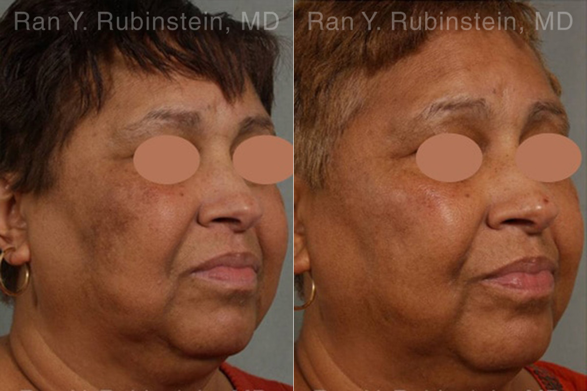 Peels & Microdermabrasion Before and After Photos in Montvale, NJ, Patient 12977