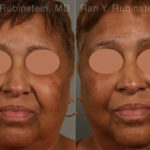 Peels & Microdermabrasion Before and After Photos in Montvale, NJ, Patient 12977