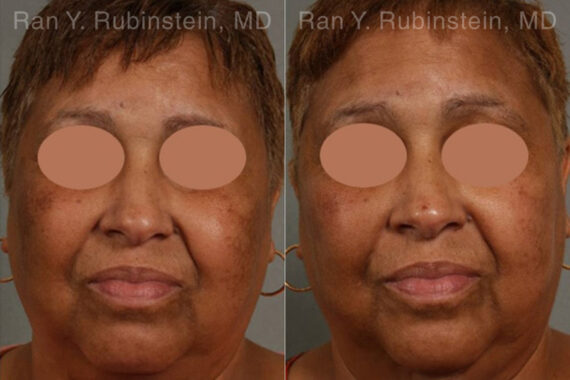 Peels & Microdermabrasion Before and After Photos in Montvale, NJ, Patient 12977