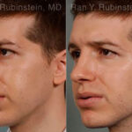 Rhinoplasty Before and After Photos in Montvale, NJ, Patient 13079