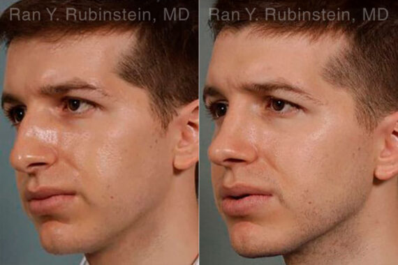 Rhinoplasty Before and After Photos in Montvale, NJ, Patient 13079