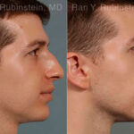 Rhinoplasty Before and After Photos in Montvale, NJ, Patient 13079