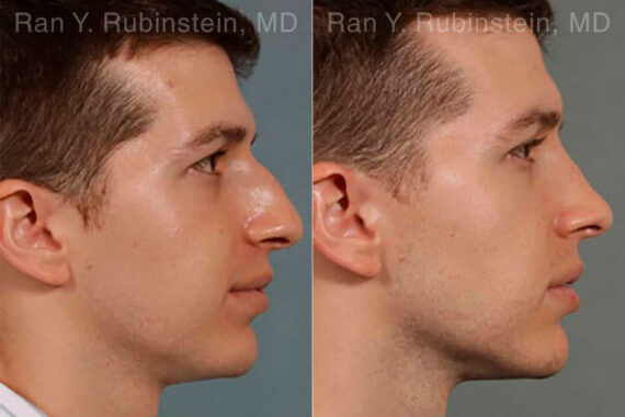 Rhinoplasty Before and After Photos in Montvale, NJ, Patient 13079