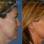 Skin Tightening Before and After Photos in Montvale, NJ, Patient 13178