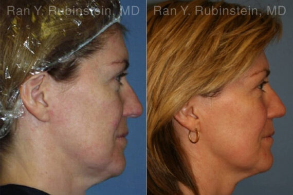 Skin Tightening Before and After Photos in Montvale, NJ, Patient 13178