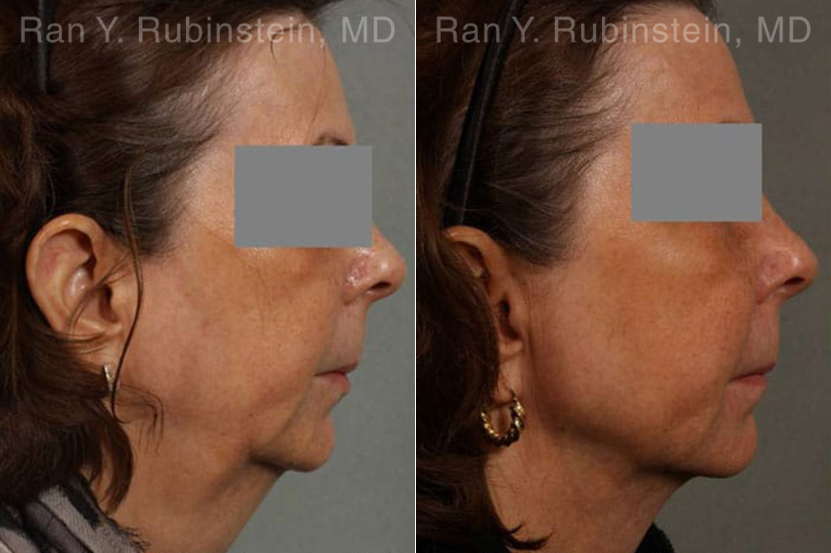 Laser Lift Precision Tx Before and After Photos in Montvale, NJ, Patient 13229