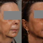 Laser Lift Precision Tx Before and After Photos in Montvale, NJ, Patient 13229