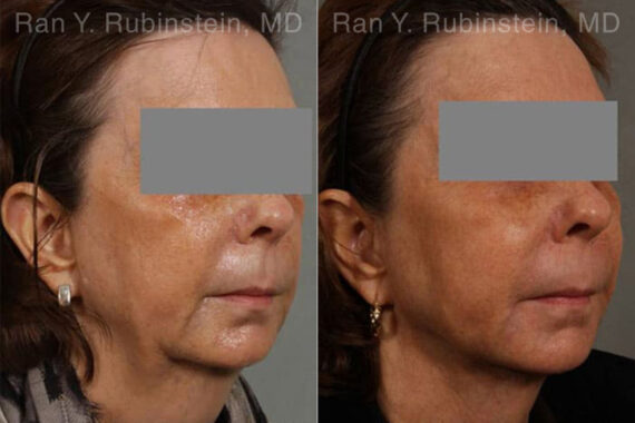 Laser Lift Precision Tx Before and After Photos in Montvale, NJ, Patient 13229