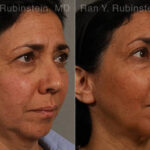 Laser Lift Precision Tx Before and After Photos in Montvale, NJ, Patient 13241