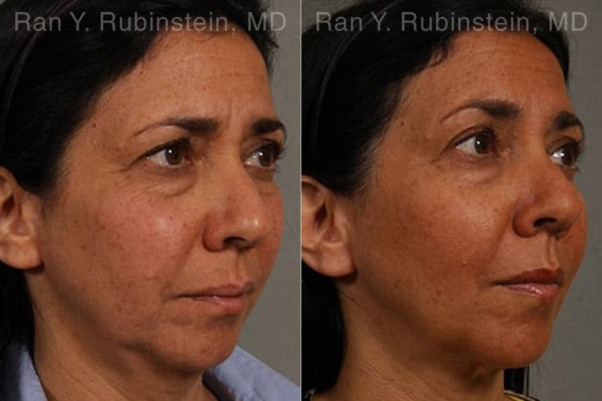 Laser Lift Precision Tx Before and After Photos in Montvale, NJ, Patient 13241