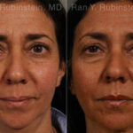 Laser Lift Precision Tx Before and After Photos in Montvale, NJ, Patient 13241