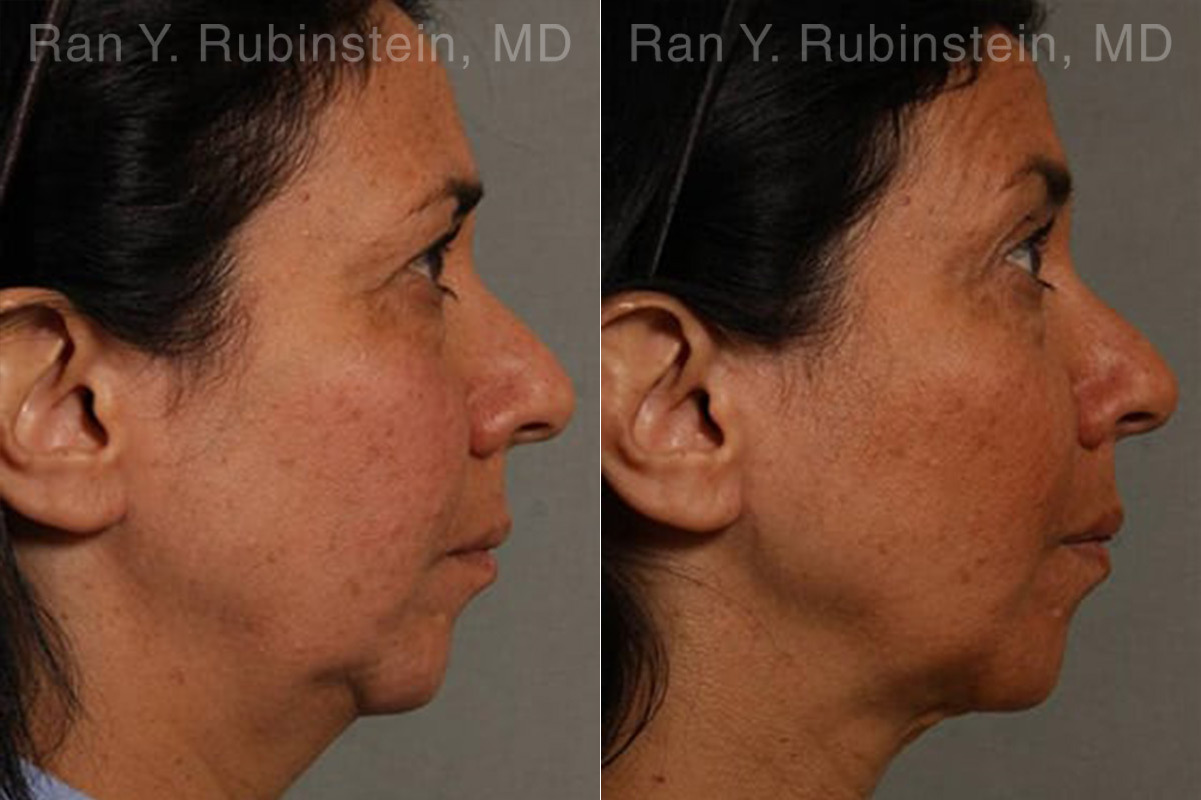 Laser Lift Precision Tx Before and After Photos in Montvale, NJ, Patient 13241