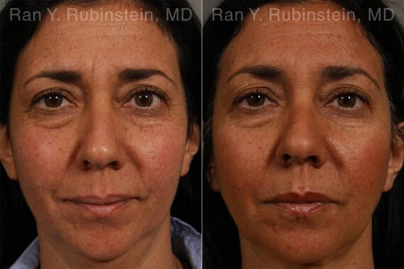 Laser Lift Precision Tx Before and After Photos in Montvale, NJ, Patient 13241