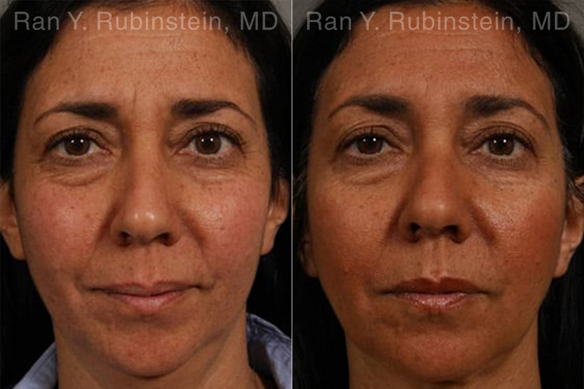 Laser Lift Precision Tx Before and After Photos in Montvale, NJ, Patient 13241