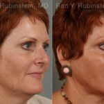 Laser Lift Precision Tx Before and After Photos in Montvale, NJ, Patient 13253