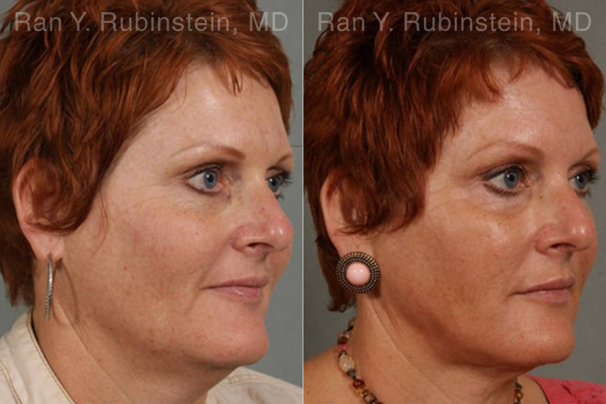 Laser Lift Precision Tx Before and After Photos in Montvale, NJ, Patient 13253