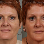 Laser Lift Precision Tx Before and After Photos in Montvale, NJ, Patient 13253