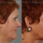 Laser Lift Precision Tx Before and After Photos in Montvale, NJ, Patient 13253