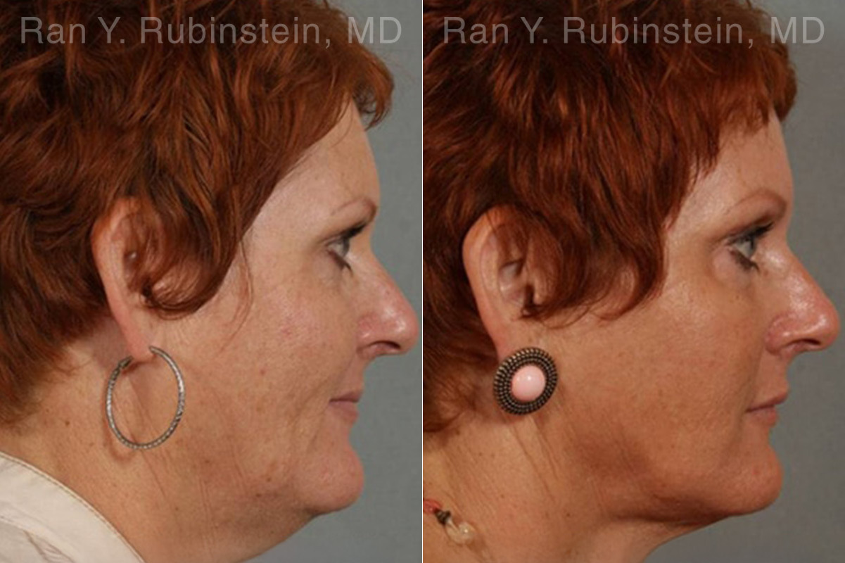 Laser Lift Precision Tx Before and After Photos in Montvale, NJ, Patient 13253