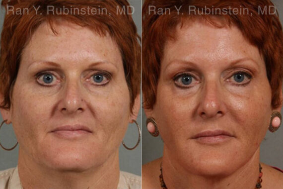 Laser Lift Precision Tx Before and After Photos in Montvale, NJ, Patient 13253