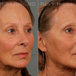 Laser Lift Precision Tx Before and After Photos in Montvale, NJ, Patient 13295