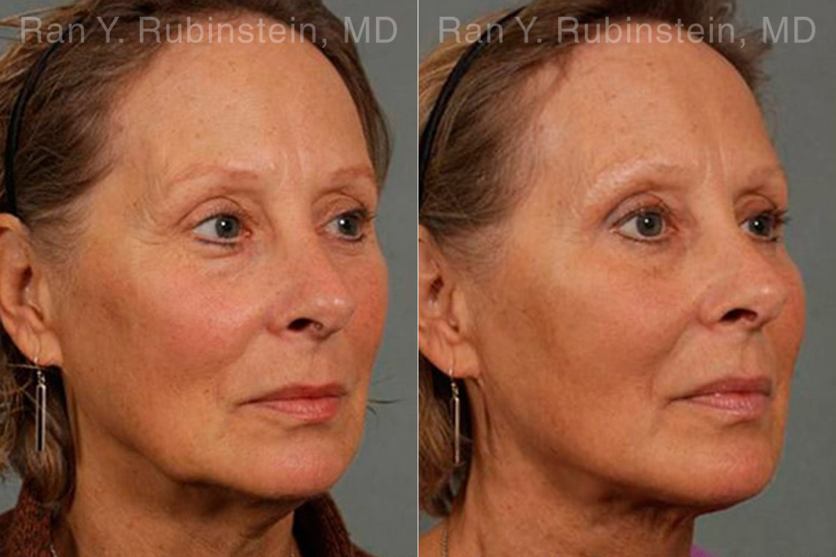 Laser Lift Precision Tx Before and After Photos in Montvale, NJ, Patient 13295